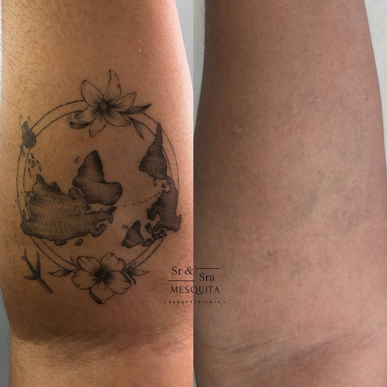 Antes e depois — remoção completa