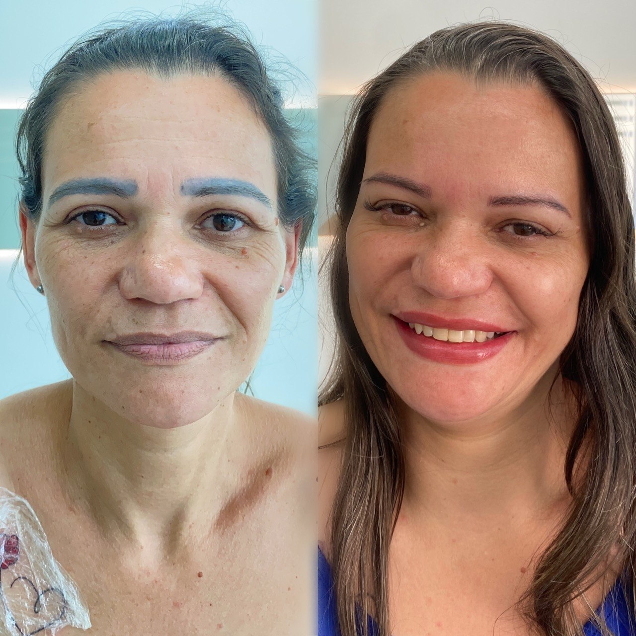 Antes e depois — remoção de micropigmentação
