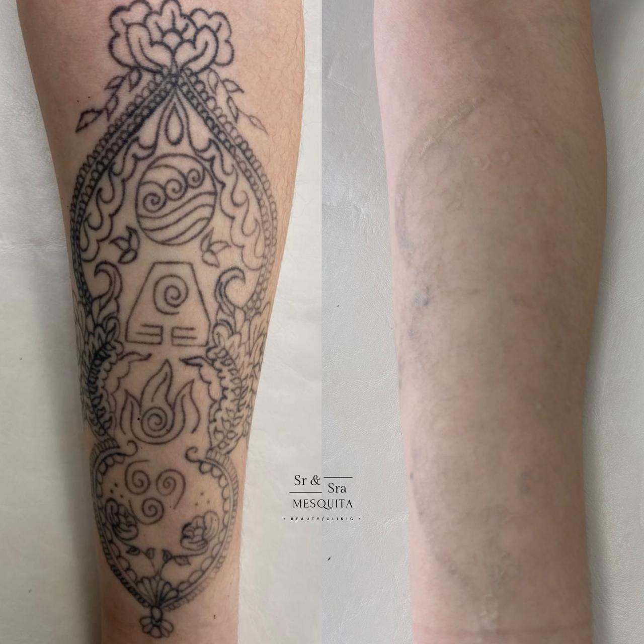 Remoção de tatuagem — antebraço